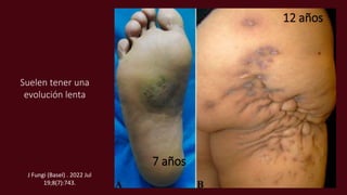 Suelen tener una
evolución lenta
J Fungi (Basel) . 2022 Jul
19;8(7):743.
7 años
12 años
 