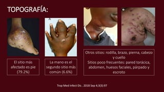 TOPOGRAFÍA:
El sitio más
afectado es pie
(79.2%)
La mano es el
segundo sitio más
común (6.6%)
Otros sitios: rodilla, brazo, pierna, cabezo
y cuello
Sitios poco frecuentes: pared torácica,
abdomen, huesos faciales, párpado y
escroto
Trop Med Infect Dis . 2018 Sep 4;3(3):97
 