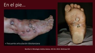 En el pie…
+ frecuente articulación tibiotarsiana
Bonifaz A. Micología médica básica. 4th Ed. 2012. McGraw Hill.
 