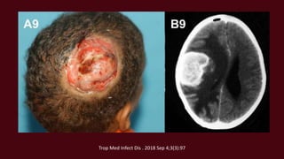 Trop Med Infect Dis . 2018 Sep 4;3(3):97
 