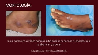 MORFOLOGÍA:
Inicia como uno o varios nódulos subcutáneos pequeños e indoloros que
se ablandan y ulceran
Indian J Dermatol . 2017 Jul-Aug;62(4):332-340.
 