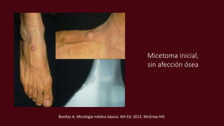 Micetoma inicial,
sin afección ósea
Bonifaz A. Micología médica básica. 4th Ed. 2012. McGraw Hill.
 