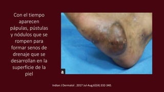 Con el tiempo
aparecen
pápulas, pústulas
y nódulos que se
rompen para
formar senos de
drenaje que se
desarrollan en la
superficie de la
piel
Indian J Dermatol . 2017 Jul-Aug;62(4):332-340.
 