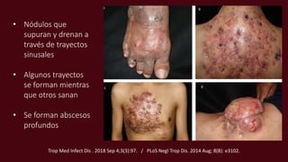 • Nódulos que
supuran y drenan a
través de trayectos
sinusales
• Algunos trayectos
se forman mientras
que otros sanan
• Se forman abscesos
profundos
Trop Med Infect Dis . 2018 Sep 4;3(3):97. / PLoS Negl Trop Dis. 2014 Aug; 8(8): e3102.
 