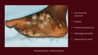 • Aumento de
volumen
• Fístulas
• Presencia de granos
• Hiperpigmentación
• Hiperhidrosis local
Trop Med Infect Dis . 2018 Sep 4;3(3):97
 