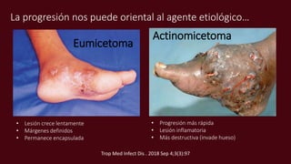 La progresión nos puede oriental al agente etiológico…
Eumicetoma
Actinomicetoma
• Lesión crece lentamente
• Márgenes definidos
• Permanece encapsulada
• Progresión más rápida
• Lesión inflamatoria
• Más destructiva (invade hueso)
Trop Med Infect Dis . 2018 Sep 4;3(3):97
 