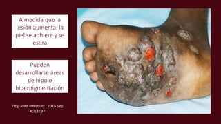 A medida que la
lesión aumenta, la
piel se adhiere y se
estira
Pueden
desarrollarse áreas
de hipo o
hiperpigmentación
Trop Med Infect Dis . 2018 Sep
4;3(3):97
 