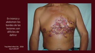 En tronco y
abdomen los
bordes de las
lesiones son
difíciles de
definir
Trop Med Infect Dis . 2018
Sep 4;3(3):97
 
