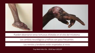 Pueden observarse venas tortuosas dilatadas en el sitio del micetoma
Los nervios y tendones están respetados al inicio
Los cambios neurológicos y tróficos son poco frecuentes
Trop Med Infect Dis . 2018 Sep 4;3(3):97
 