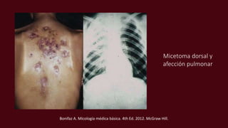 Micetoma dorsal y
afección pulmonar
Bonifaz A. Micología médica básica. 4th Ed. 2012. McGraw Hill.
 