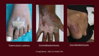 Tuberculosis cutánea Cromoblastomicosis Coccidioidomicosis
J Fungi (Basel) . 2022 Jul 19;8(7):743.
 