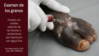 Examen de
los granos
Pueden ser
visibles
saliendo de
las fístulas o
recolectarse
por aspiración
con aguja fina
PLoS Negl Trop Dis. 2017
Aug; 11(8): e0005638.
 