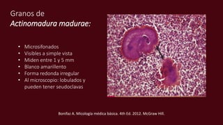 Granos de
Actinomadura madurae:
• Microsifonados
• Visibles a simple vista
• Miden entre 1 y 5 mm
• Blanco amarillento
• Forma redonda irregular
• Al microscopio: lobulados y
pueden tener seudoclavas
Bonifaz A. Micología médica básica. 4th Ed. 2012. McGraw Hill.
 