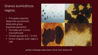 Granos eumicéticos
negros:
• Principales especies:
Madurella mycetomatis
Madurella grisea
Exophiala jeanselmei
• Formados por micelio
macrosifonado
• Tamaño grande (0.5 – 5 mm)
• Forma irregular, color negro o
café
Bonifaz A. Micología médica básica. 4th Ed. 2012. McGraw Hill.
 