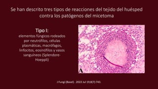 Se han descrito tres tipos de reacciones del tejido del huésped
contra los patógenos del micetoma
Tipo I:
elementos fúngicos rodeados
por neutrófilos, células
plasmáticas, macrófagos,
linfocitos, eosinófilos y vasos
sanguíneos (Splendore-
Hoeppli)
J Fungi (Basel) . 2022 Jul 19;8(7):743.
 