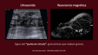 Ultrasonido Resonancia magnética
Signo del “punto en círculo”: granulomas que rodean granos
Clin Exp Dermatol . 2019 Mar;44(2):123-129.
 