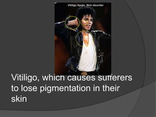 Vitiligo, which causes sufferers
to lose pigmentation in their
skin
 