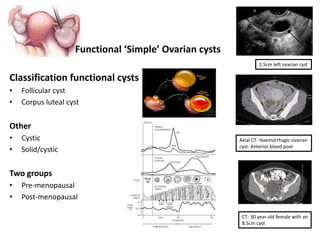 Adnexal masses - Ovarian Cysts (2008) | PDF