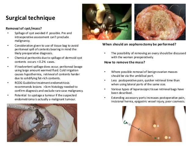 Adnexal Masses Ovarian Cysts 2008