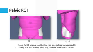 Pelvic ROI
AP RT LAT
• Ensure the ROI wraps around the iliac crest anteriorly as much as possible
• Drawing an ROI too inferior on leg may introduce unwanted pitch issues
 