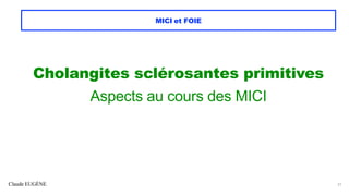 Claude EUGÈNE
MICI et FOIE
Cholangites sclérosantes primitives
Aspects au cours des MICI
21
 