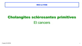 Claude EUGÈNE
MICI et FOIE
Cholangites sclérosantes primitives
Et cancers
27
 