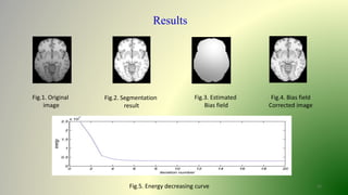 12
Results
Fig.1. Original
image
Fig.2. Segmentation
result
Fig.3. Estimated
Bias field
Fig.4. Bias field
Corrected image
Fig.5. Energy decreasing curve
 