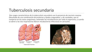 Tuberculosis secundaria
Dos rasgos característicos de la tuberculosis secundaria son la presencia de necrosis caseosa
(Resultado de una combinación de proteínas y lípidos coagulados) y de cavidades, que al
romperse en los vasos sanguíneos, extienden las micobacterias por todo el organismo, y cuando
se abren a las vías respiratorias liberan micobacterias infecciosas en aerosoles.
 