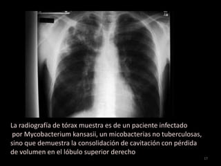 Lobulo Infectado Micobacterias atípicas | PPTX