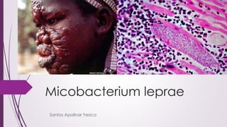 Micobacterium leprae
Santos Apolinar Yesica
 