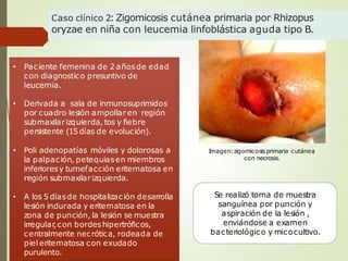 Caso clínico 2:Zigomicosis cutánea primaria por Rhizopus
oryzae en niña con leucemia linfoblástica aguda tipo B.
• Paciente femenina de 2 añosde edad
con diagnostico presuntivo de
leucemia.
• Derivada a sala de inmunosuprimidos
por cuadro lesión ampollaren región
submaxilarizquierda, tos y fiebre
persistente (15 días de evolución).
• Poli adenopatías móviles y dolorosas a
la palpación, petequiasen miembros
inferioresy tumefacción eritematosa en
región submaxilarizquierda.
• A los 5 díasde hospitalización desarrolla
lesión indurada y eritematosa en la
zona de punción, la lesión se muestra
irregular
,con bordeshipertróficos,
centralmente necrótica, rodeada de
piel eritematosa con exudado
purulento.
Imagen:zigomicosis primaria cutánea
con necrosis.
Se realizó toma de muestra
sanguínea por punción y
aspiración de la lesión ,
enviándose a examen
bacteriológico y micocultivo.
 