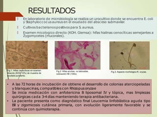 RESULTADOS
🠶 En laboratorio de microbiología se realiza un urocultivo donde se encuentra E. coli
y Staphyloccocusaureusen el exudado del absceso submaxilar.
🠶 Cultivosbacterianospositivospara S
. aureus.
🠶 Examen micologico directo (KOH. Giemsa): hifas hialinas cenocíticas semejantes a
Zygomycetes (mucorales).
• A las 72 horas de incubación de obtiene el desarrollo de colonias aterciopeladas
y blanquecinas, compatiblescon Rhizopusoryzae
• Se inicia medicación con anfotericina B liposomal IV y tópica, mas limpiezas
quirúrgicas cada 3-4 días manteniendo terapia antibacteriana.
• La paciente presenta como diagnóstico final Leucemia linfoblástica aguda tipo
Bll y zigomicosis cutánea primaria, con evolución ligeramente favorable y se
continúa con quimioterapia.
Fig.1. Hifas cenocíticas en examen
direccto (KOH 10%) de muestra de
exudado purulento.
Fig.2. Hifas anchas no tabicadas,
coloración HE (100x).
Fig.3. Aspecto morfológico R. oryzae.
 