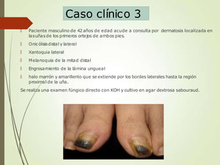 Caso clínico 3
🠶 Paciente masculino de 42 años de edad acude a consulta por dermatosis localizada en
lasuñasde los primeros ortejos de ambos pies.
🠶 Onicólisisdistal y lateral
🠶 Xantoquia lateral
🠶 Melanoquia de la mitad distal
🠶 Engrosamiento de la lámina ungueal
🠶 halo marrón y amarillento que se extiende por los bordes laterales hasta la región
proximal de la uña.
Se realiza una examen fúngico directo con KOH y cultivo en agar dextrosa sabouraud.
oquia
 