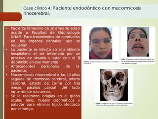Caso clínico 4:Paciente endodóntico con mucormicosis
rinocerebral.
• Paciente femenino de 20 años de edad
acude a Facultad de Odontología
UNAM. Para tratamientos de conductos
en los órganos dentales que se
requerían.
• La paciente se infectó en el ambiente
hospitalario al ser internada por un
proceso de sinusitis y estar con el S
I
deprimido en ese momento.
• Antecedentes personales de la
paciente:
• Mucormicosis rinocerebral a los 14 años
seguida de trombosis cerebral, infarto
cerebral, estado de coma por tres
meses, parálisis parcial del lado
izquierdo de su cuerpo.
• Se le realizaron cirugías en el globo
ocular, nariz, huesos cigomáticos y
paladar para eliminar tejido afectado
por el hongo.
 