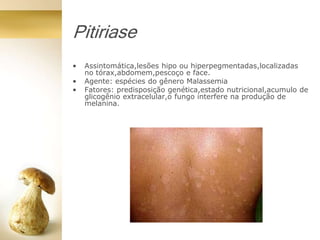 Pitiriase
• Assintomática,lesões hipo ou hiperpegmentadas,localizadas
no tórax,abdomem,pescoço e face.
• Agente: espécies do gênero Malassemia
• Fatores: predisposição genética,estado nutricional,acumulo de
glicogênio extracelular,o fungo interfere na produção de
melanina.
 