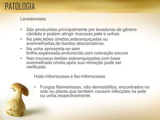 Leveduroses
• São produzidas principalmente por leveduras do gênero
cândida e podem atingir mucosas,pele e unhas.
• Na pele,leões úmidas,esbranquiçadas ou
avermelhadas,de bordos descamativos.
• Na unha apresenta-se sem
brilho,espessada,endurecida,com coloração escura
• Nas mucosas lesões esbranquiçadas,com base
avermelhada úmida,após sua remoção pode ser
verificada.
PATOLOGIA
Hialo-hifomicoses e feo-hifomicoses
• Fungos filamentosos, não dermatófitos, encontrados no
solo ou planta,que também causam infecções na pele
ou unha,respectivamente.
 
