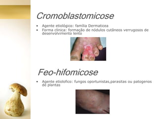 Cromoblastomicose
• Agente etiológico: família Dermaticea
• Forma clinica: formação de nódulos cutâneos verrugosos de
desenvolvimento lento
Feo-hifomicose
• Agente etiolofico: fungos oportunistas,parasitas ou patogenos
de plantas
 