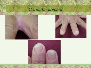 Candida albicans 