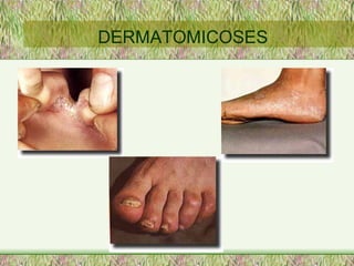 DERMATOMICOSES 