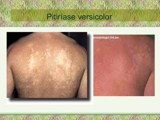 Pitiríase versicolor 