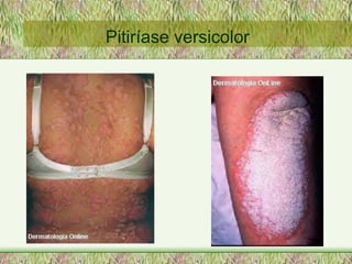 Pitiríase versicolor 