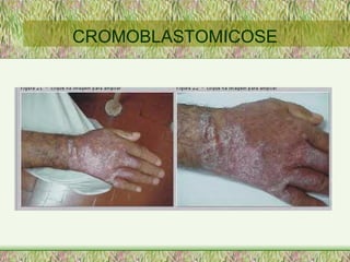 CROMOBLASTOMICOSE 
