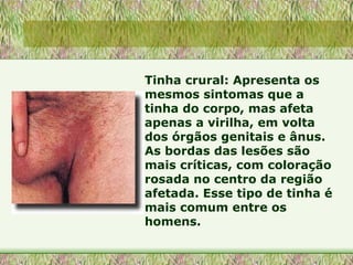 Tinha crural: Apresenta os mesmos sintomas que a tinha do corpo, mas afeta apenas a virilha, em volta dos órgãos genitais e ânus. As bordas das lesões são mais críticas, com coloração rosada no centro da região afetada. Esse tipo de tinha é mais comum entre os homens.  