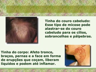 Tinha do corpo: Afeto tronco, braços, pernas e a face em forma de erupções que coçam, liberam líquidos e podem até inflamar. Tinha do couro cabeludo: Esse tipo de micose pode alastrar-se do couro cabeludo para os cílios, sobrancelhas e pálpebras. 