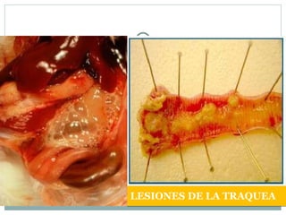 LESIONES DE LA TRAQUEA 