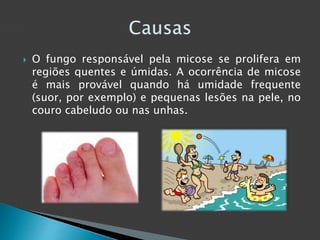  O fungo responsável pela micose se prolifera em 
regiões quentes e úmidas. A ocorrência de micose 
é mais provável quando há umidade frequente 
(suor, por exemplo) e pequenas lesões na pele, no 
couro cabeludo ou nas unhas. 
 