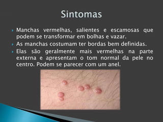  Manchas vermelhas, salientes e escamosas que 
podem se transformar em bolhas e vazar. 
 As manchas costumam ter bordas bem definidas. 
 Elas são geralmente mais vermelhas na parte 
externa e apresentam o tom normal da pele no 
centro. Podem se parecer com um anel. 
 