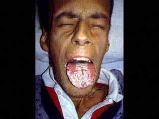 O fungo tem poder invasor em pessoas com doenças crônicas, debilitados por tratamento prolongado com antibióticos e drogas imunossupressoras.   