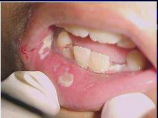 Fatores de Virulência: Variações de antígeno de parede Enzimas = proteinases e fosfolipases b Variações fenotípicas)  Amanda