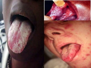 CANDIDÍASEPATOGÊNIA: Mucosa oral (estomatite ou sapinho) – placas brancas, isoladas ou confluentes, aderentes à mucosa, com aspecto membranoso, rodeadas por halo eritematoso.  Pacientes gravemente enfermos e recém-nascidos de mãe com candidíase vaginal.  Amanda